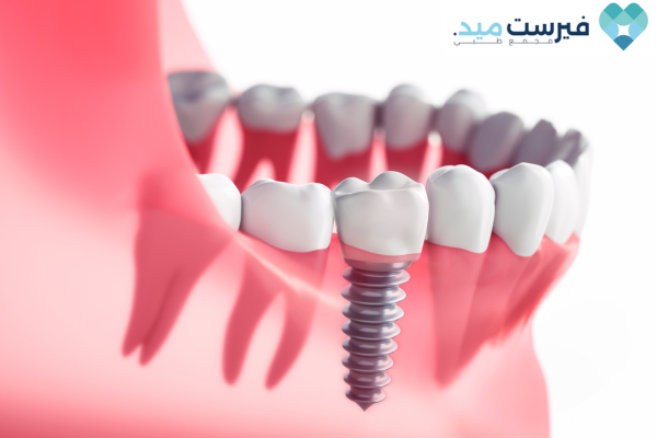 زراعة أسنان في عمان الأردن